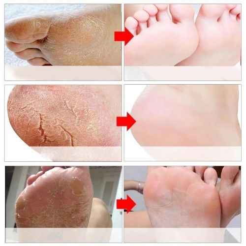 Exfoliating Foot Peel Mask 3-Pack — Remove Dead Skin for Baby-Soft Feet in One Week