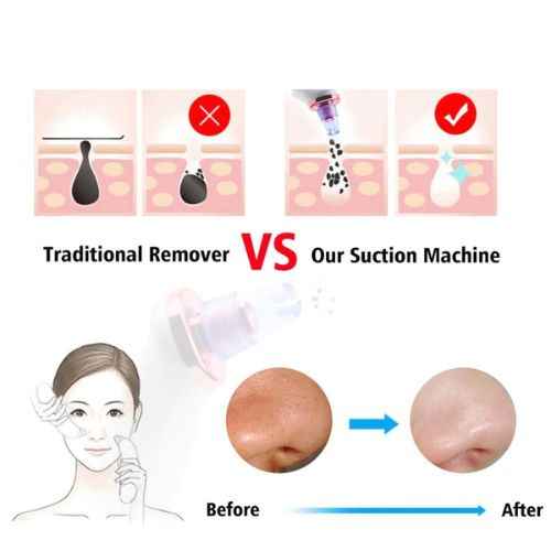 Blackhead Removal Suction Tool — Manual Vacuum Extractor for Deep Pore Cleansing Without Chemicals