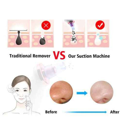 Blackhead Removal Suction Tool — Manual Vacuum Extractor for Deep Pore Cleansing Without Chemicals