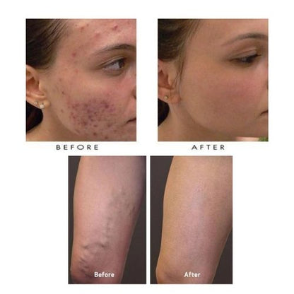 Blue Light Therapy Pen — Targeted Acne Spot Treatment Device Canada SBDS WORD